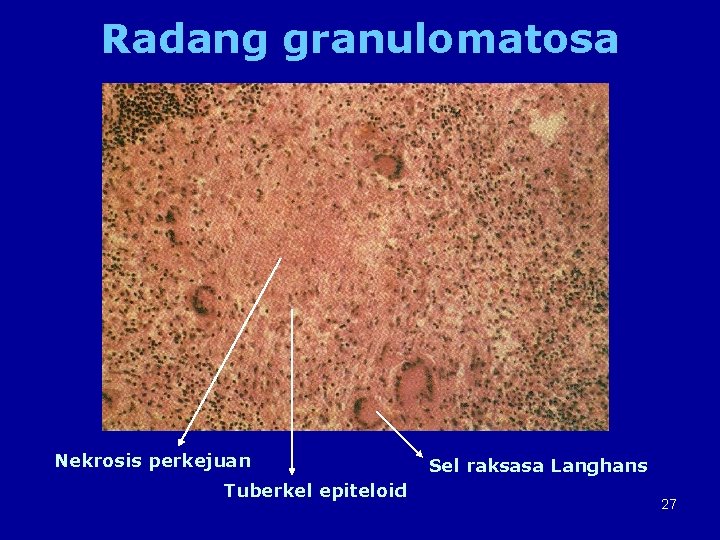 Radang granulomatosa Nekrosis perkejuan Tuberkel epiteloid Sel raksasa Langhans 27 