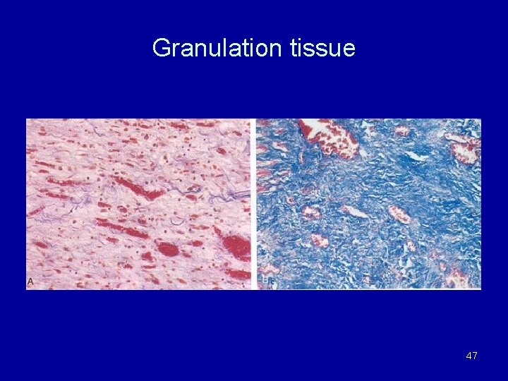 Granulation tissue 47 