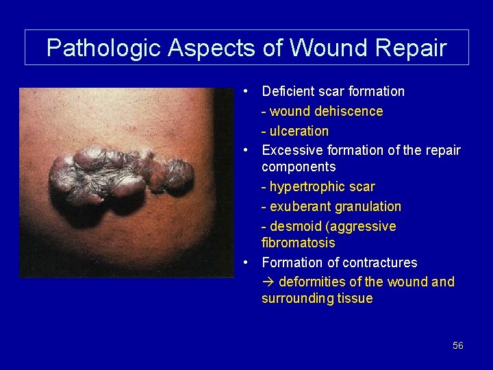 Pathologic Aspects of Wound Repair • Deficient scar formation - wound dehiscence - ulceration