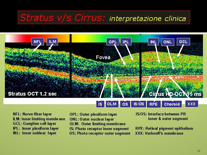 Stratus v/s Cirrus: NFL ILM interpretazione clinica OPL INL ONL GCL Fovea Stratus OCT