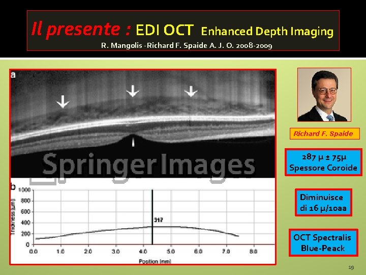 Il presente : EDI OCT Enhanced Depth Imaging R. Mangolis -Richard F. Spaide A.