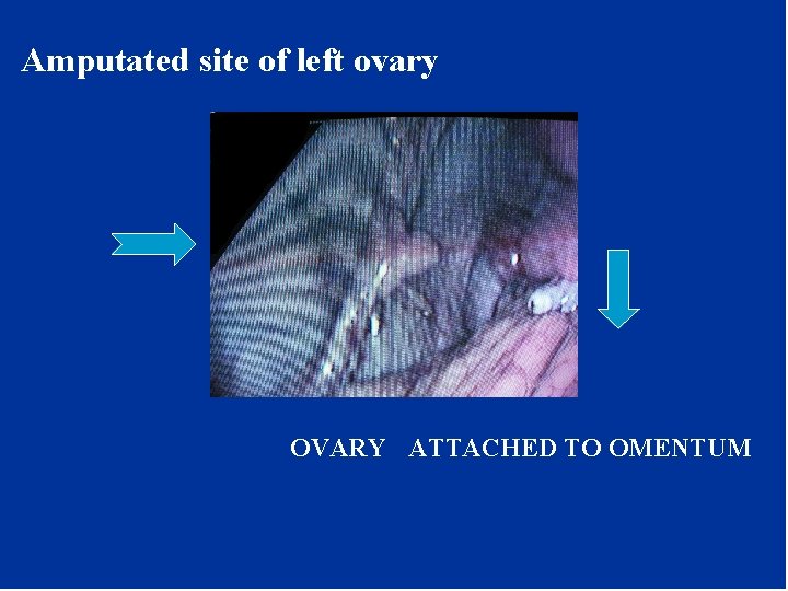 Amputated site of left ovary OVARY ATTACHED TO OMENTUM Amputated site of left ovary OVARY ATTACHED TO OMENTUM