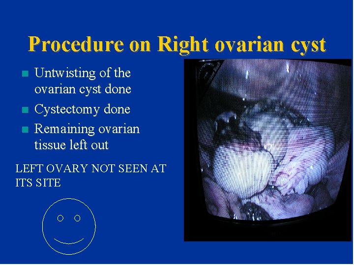 Procedure on Right ovarian cyst n n n Untwisting of the ovarian cyst done Procedure on Right ovarian cyst n n n Untwisting of the ovarian cyst done