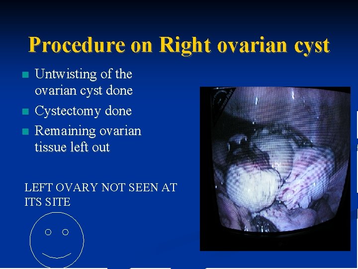 Procedure on Right ovarian cyst n n n Untwisting of the ovarian cyst done Procedure on Right ovarian cyst n n n Untwisting of the ovarian cyst done