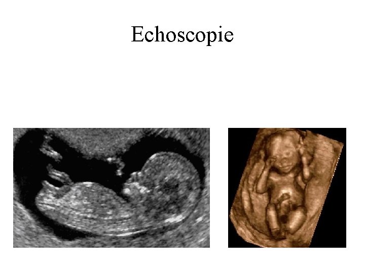 Echoscopie 