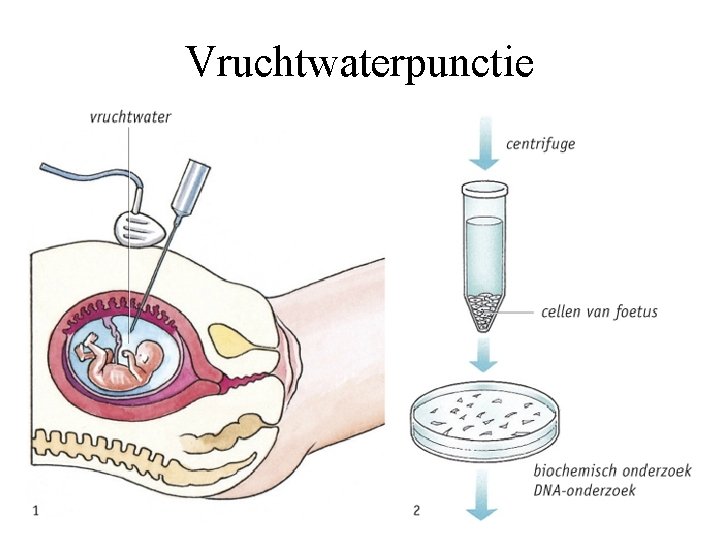 Vruchtwaterpunctie 