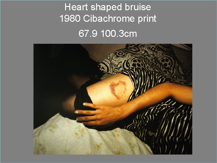 Heart shaped bruise 1980 Cibachrome print 67. 9 100. 3 cm 