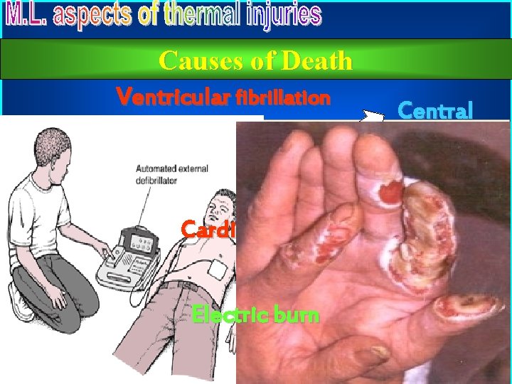 Causes of Death Ventricular fibrillation Central Respiratory failure Cardiac arrest Cerebral anoxia Electric burn