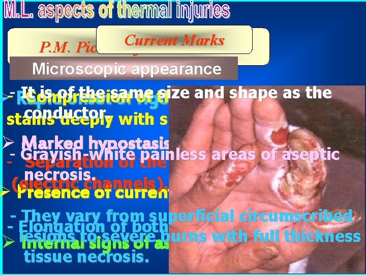 Marks P. M. Picture. Current of Electric Burn NMicroscopic / E appearance It is