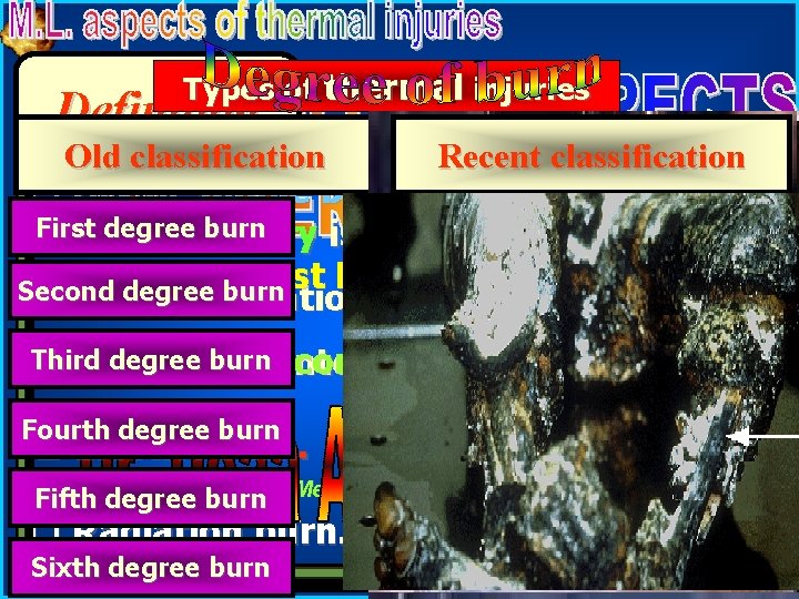 Types of thermal injuries Definition Old classification Recent classification q Dry or simple burn.