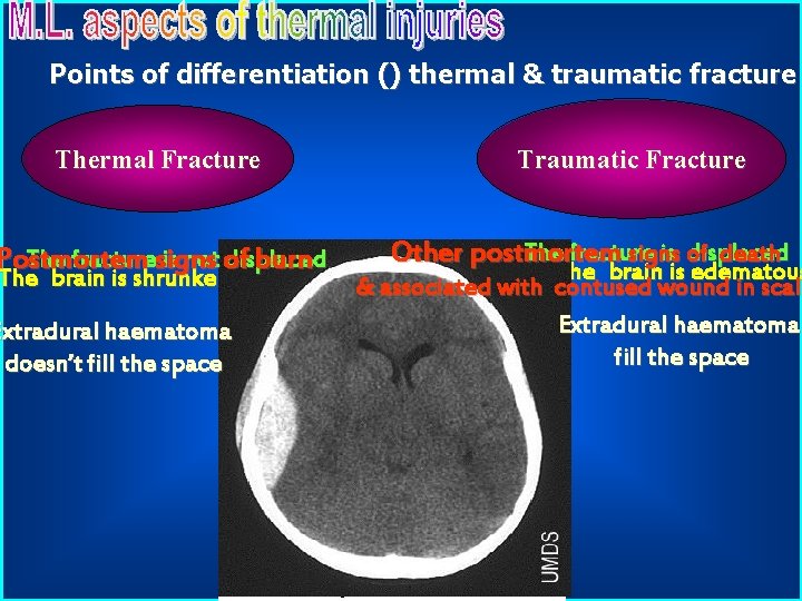 Points of differentiation () thermal & traumatic fracture Thermal Fracture The fracturesigns is not