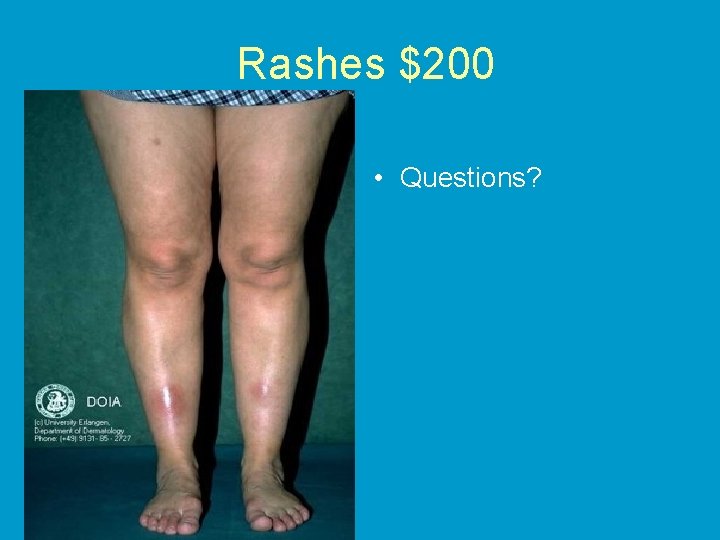Rashes $200 • Questions? 