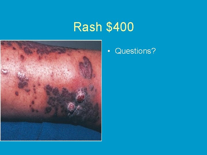 Rash $400 • Questions? 