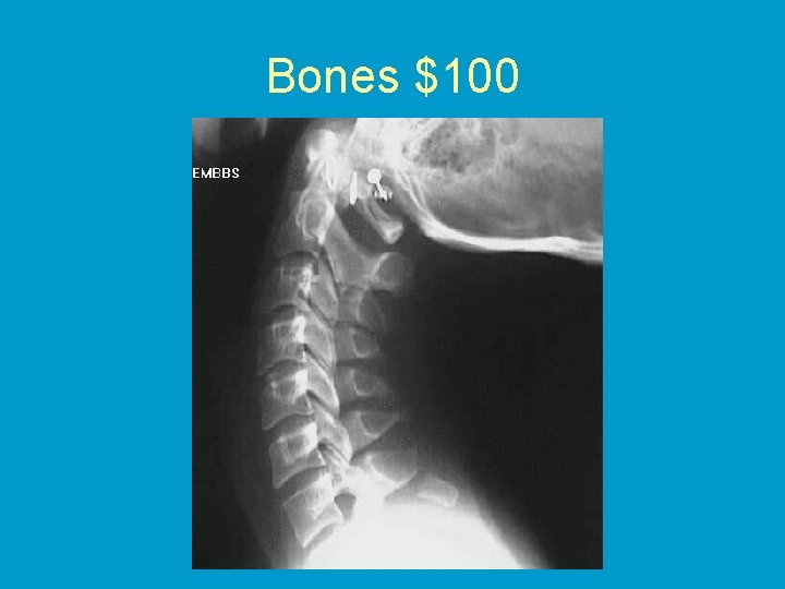 Bones $100 