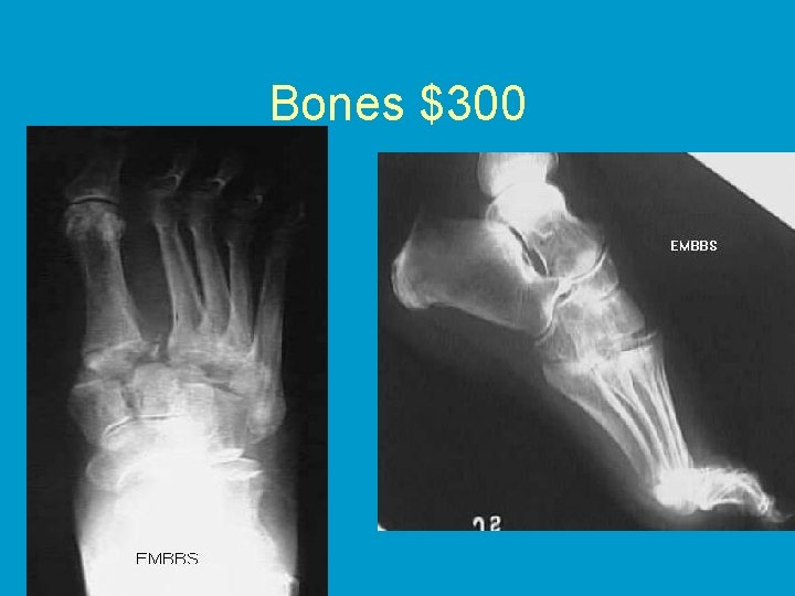 Bones $300 