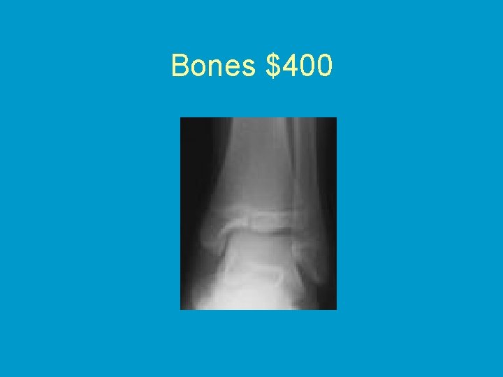 Bones $400 