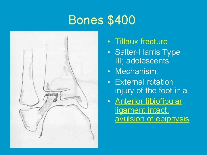Bones $400 • Tillaux fracture • Salter-Harris Type III; adolescents • Mechanism: • External