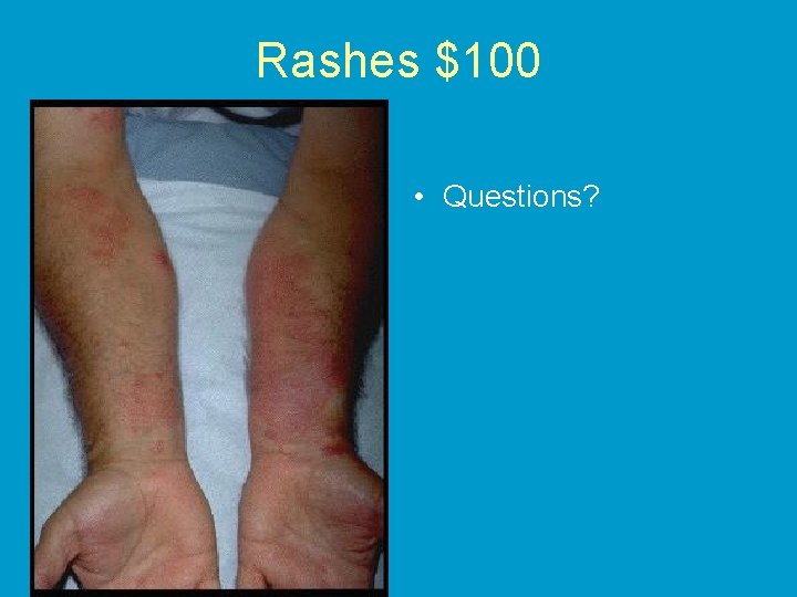 Rashes $100 • Questions? 