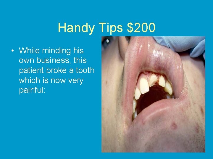 Handy Tips $200 • While minding his own business, this patient broke a tooth