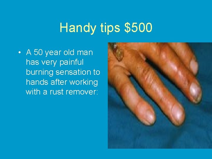 Handy tips $500 • A 50 year old man has very painful burning sensation