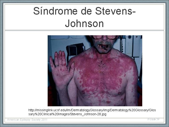 Síndrome de Stevens. Johnson http: //missinglink. ucsf. edu/lm/Dermatology. Glossary/img/Dermatology%20 Glossary/Glos sary%20 Clinical%20 Images/Stevens_Johnson-28. jpg