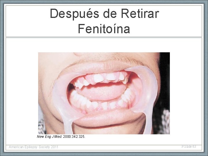 Después de Retirar Fenitoína New Eng J Med. 2000: 342: 325. American Epilepsy Society