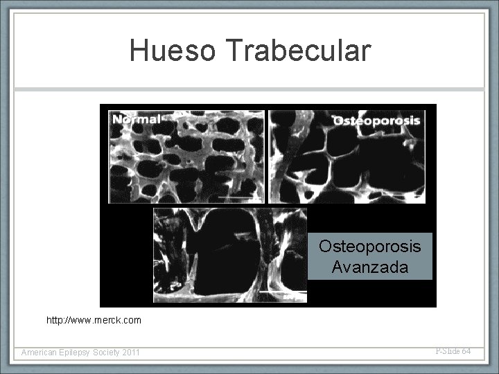 Hueso Trabecular Osteoporosis Avanzada http: //www. merck. com American Epilepsy Society 2011 P-Slide 64