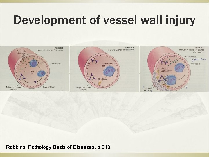 Development of vessel wall injury Robbins, Pathology Basis of Diseases, p. 213 Development of vessel wall injury Robbins, Pathology Basis of Diseases, p. 213