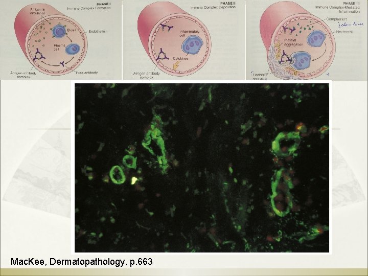 Mac. Kee, Dermatopathology, p. 663 Mac. Kee, Dermatopathology, p. 663