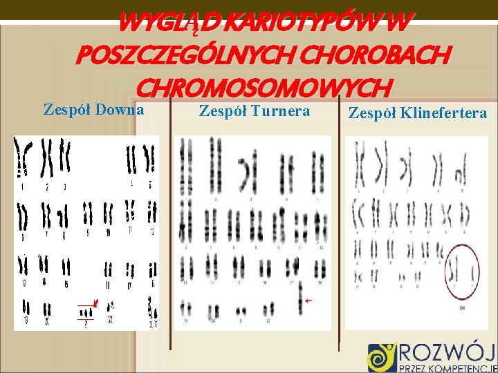 WYGLĄD KARIOTYPÓW W POSZCZEGÓLNYCH CHOROBACH CHROMOSOMOWYCH Zespół Downa Zespół Turnera Zespół Klinefertera 