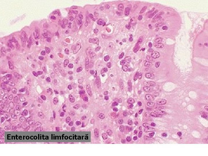 Enterocolita limfocitară 