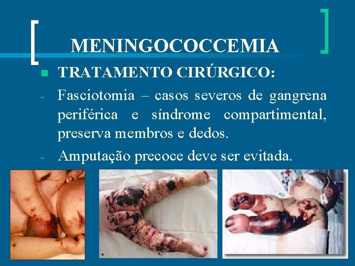 MENINGOCOCCEMIA n - - TRATAMENTO CIRÚRGICO: Fasciotomia – casos severos de gangrena periférica e