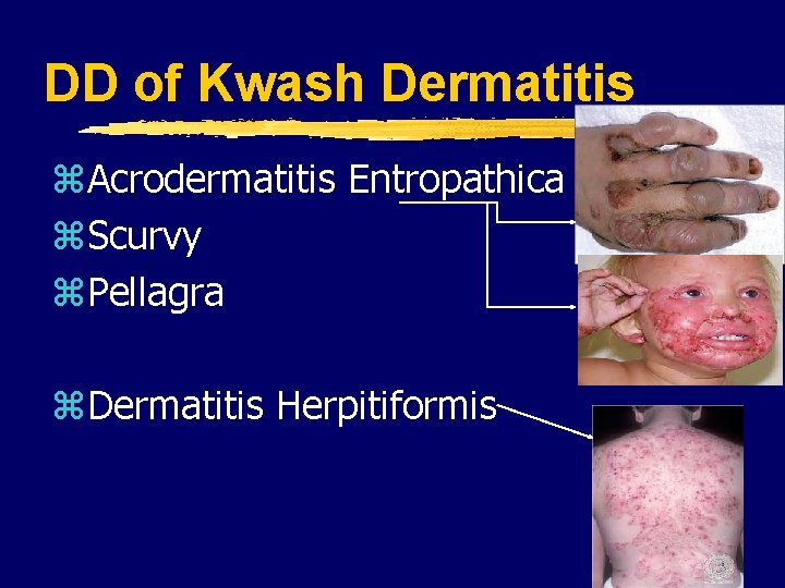DD of Kwash Dermatitis z. Acrodermatitis Entropathica z. Scurvy z. Pellagra z. Dermatitis Herpitiformis DD of Kwash Dermatitis z. Acrodermatitis Entropathica z. Scurvy z. Pellagra z. Dermatitis Herpitiformis
