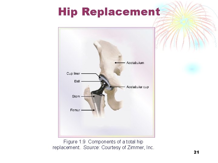 Hip Replacement Figure 1. 9 Components of a total hip replacement. Source: Courtesy of