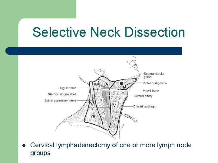 Selective Neck Dissection l Cervical lymphadenectomy of one or more lymph node groups 