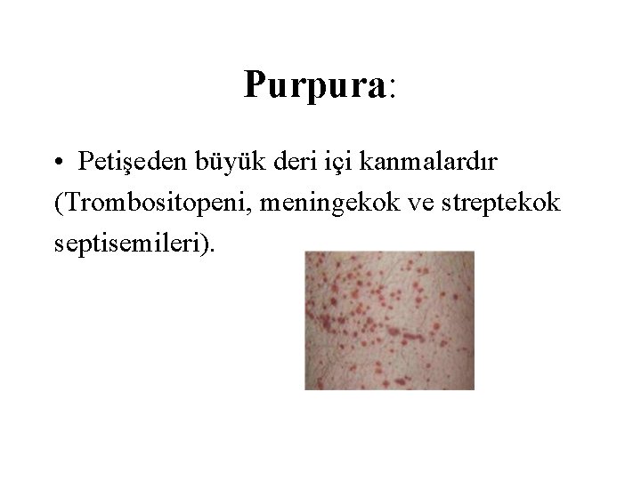 Purpura: • Petişeden büyük deri içi kanmalardır (Trombositopeni, meningekok ve streptekok septisemileri). 