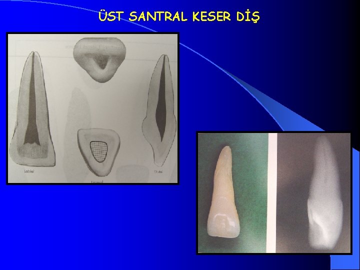 ÜST SANTRAL KESER DİŞ 