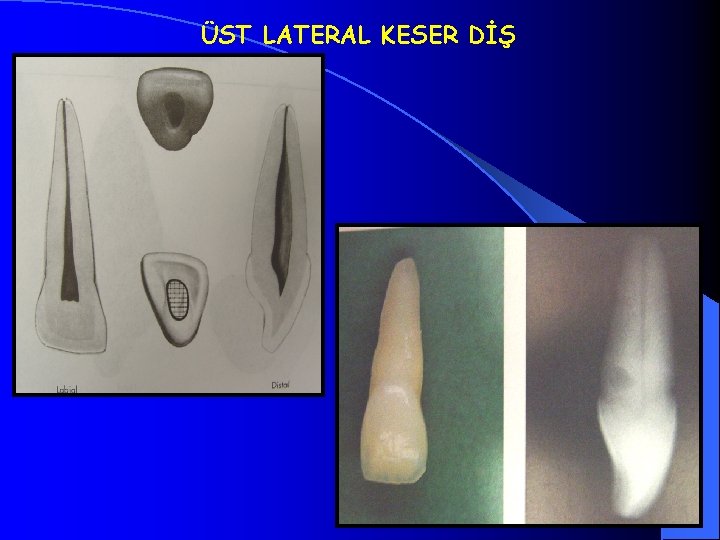 ÜST LATERAL KESER DİŞ 