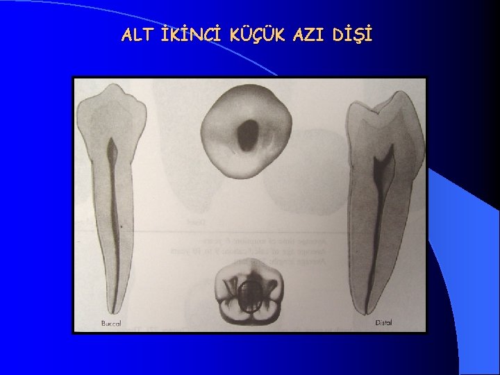 ALT İKİNCİ KÜÇÜK AZI DİŞİ 