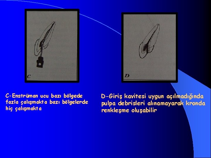 C-Enstrüman ucu bazı bölgede fazla çalışmakta bazı bölgelerde hiç çalışmakta D-Giriş kavitesi uygun açılmadığında