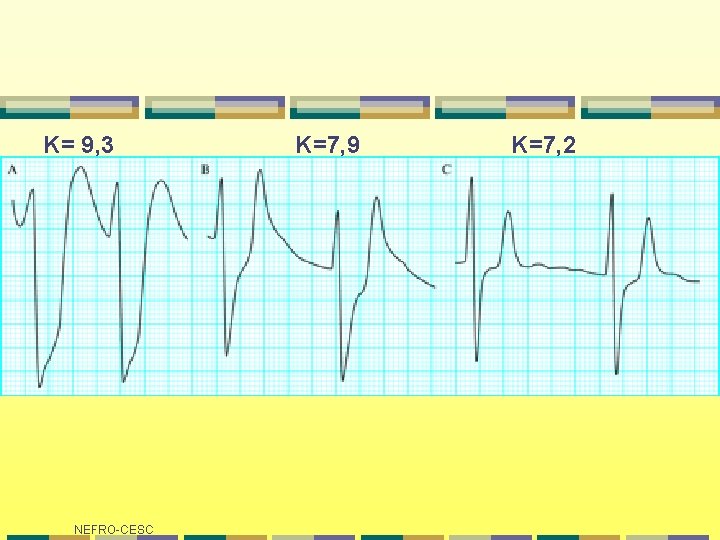K= 9, 3 NEFRO-CESC K=7, 9 K=7, 2 K= 9, 3 NEFRO-CESC K=7, 9 K=7, 2
