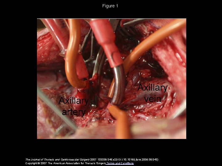 Figure 1 The Journal of Thoracic and Cardiovascular Surgery 2007 133339 -345. e 2 Figure 1 The Journal of Thoracic and Cardiovascular Surgery 2007 133339 -345. e 2