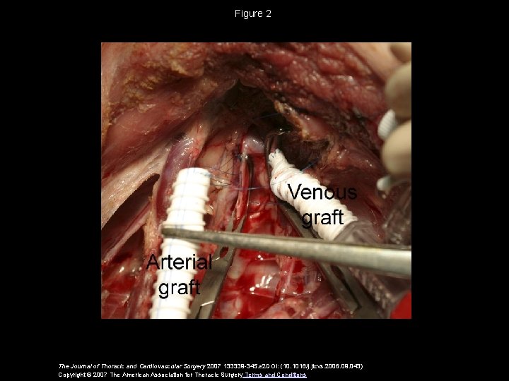 Figure 2 The Journal of Thoracic and Cardiovascular Surgery 2007 133339 -345. e 2 Figure 2 The Journal of Thoracic and Cardiovascular Surgery 2007 133339 -345. e 2