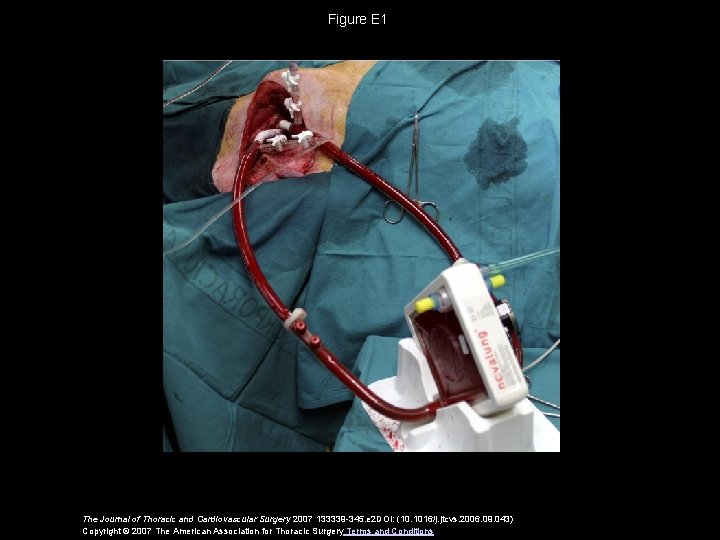 Figure E 1 The Journal of Thoracic and Cardiovascular Surgery 2007 133339 -345. e Figure E 1 The Journal of Thoracic and Cardiovascular Surgery 2007 133339 -345. e
