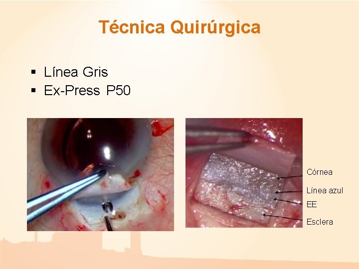 Técnica Quirúrgica § Línea Gris § Ex-Press P 50 Córnea Línea azul EE Esclera Técnica Quirúrgica § Línea Gris § Ex-Press P 50 Córnea Línea azul EE Esclera