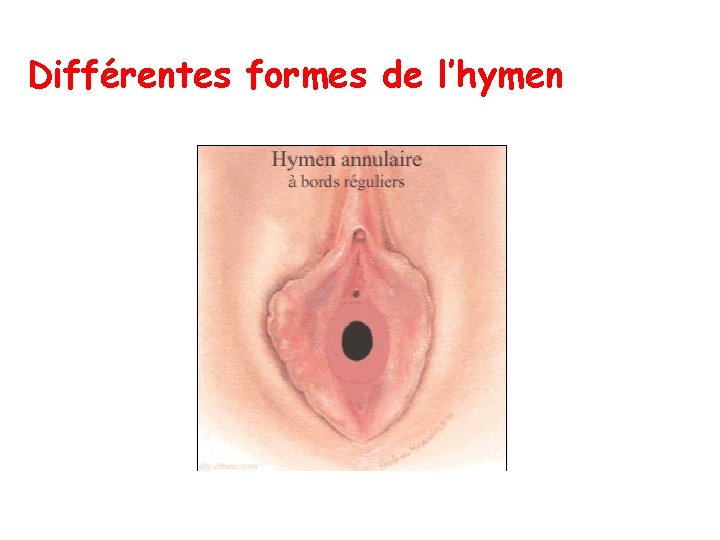 Différentes formes de l’hymen Différentes formes de l’hymen