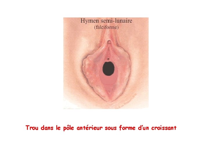 Trou dans le pôle antérieur sous forme d’un croissant Trou dans le pôle antérieur sous forme d’un croissant