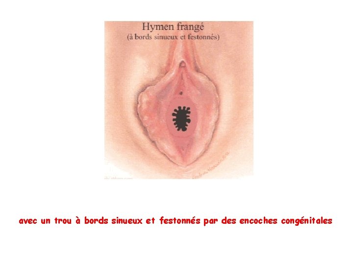 avec un trou à bords sinueux et festonnés par des encoches congénitales avec un trou à bords sinueux et festonnés par des encoches congénitales