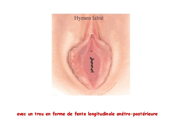 avec un trou en forme de fente longitudinale anétro-postérieure avec un trou en forme de fente longitudinale anétro-postérieure