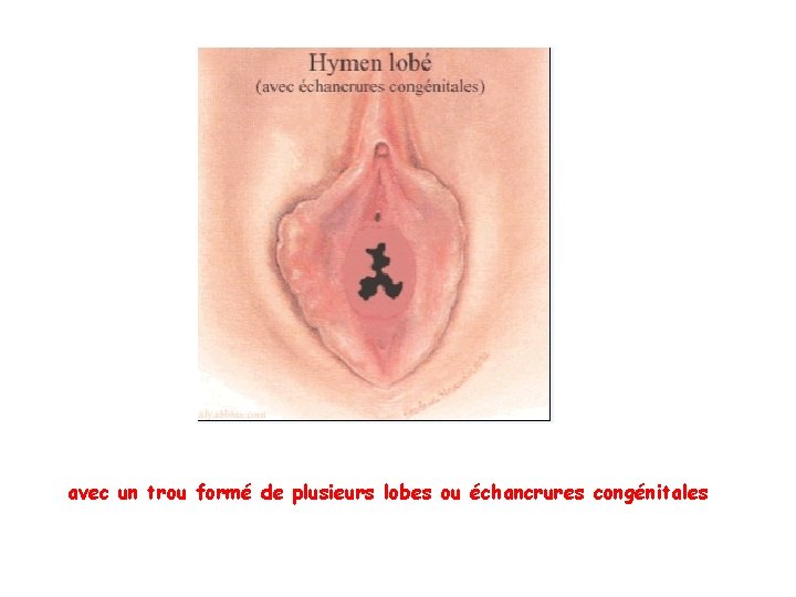 avec un trou formé de plusieurs lobes ou échancrures congénitales avec un trou formé de plusieurs lobes ou échancrures congénitales